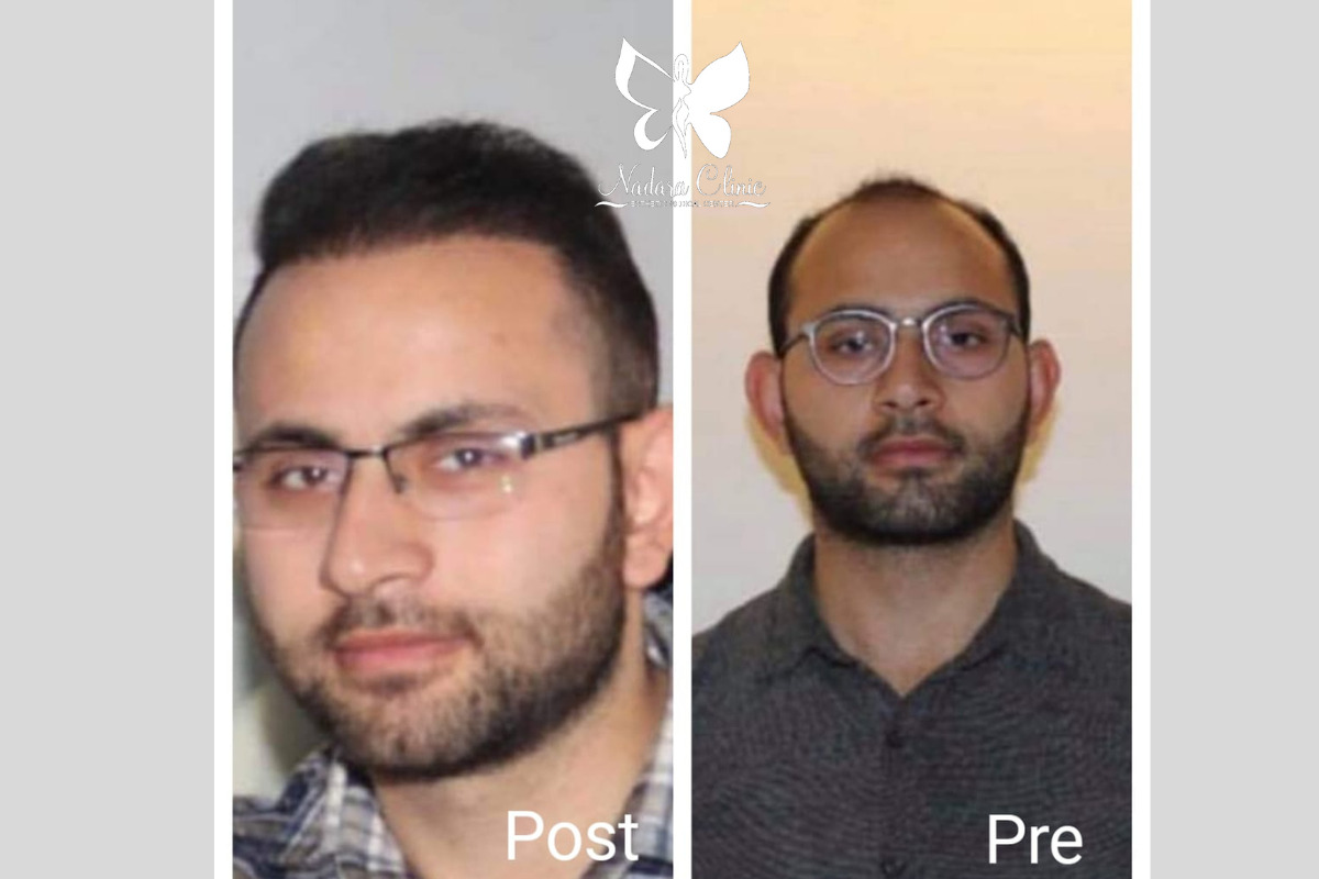 اطباء زراعة الشعر في مصر